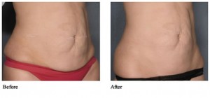 female-abdomen cellulite treatment lipolysis