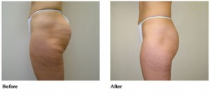 female-thighs cellulite treatment lipolysis